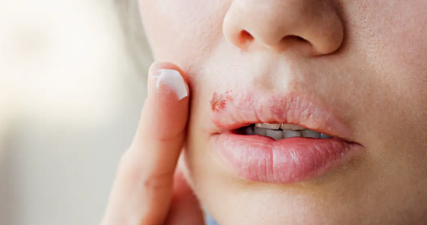 Is Lemon Balm Extract Good For Herpes? Is Lemon Balm Extract Good For Herpes?