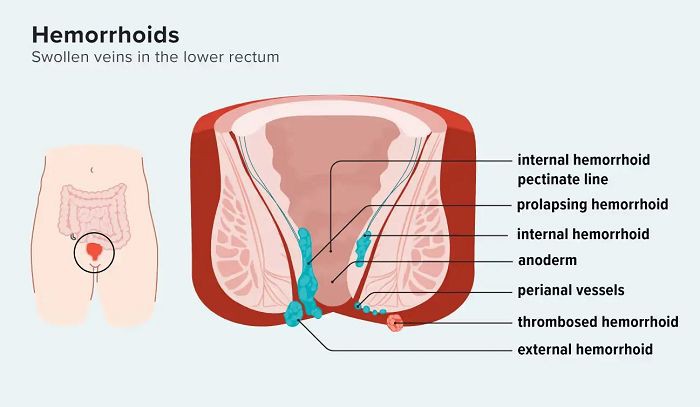 Why Does Horse Chestnut Extract Have Effective Benefits for Hemorrhoids? Why Does Horse Chestnut Extract Have Effective Benefits for Hemorrhoids?